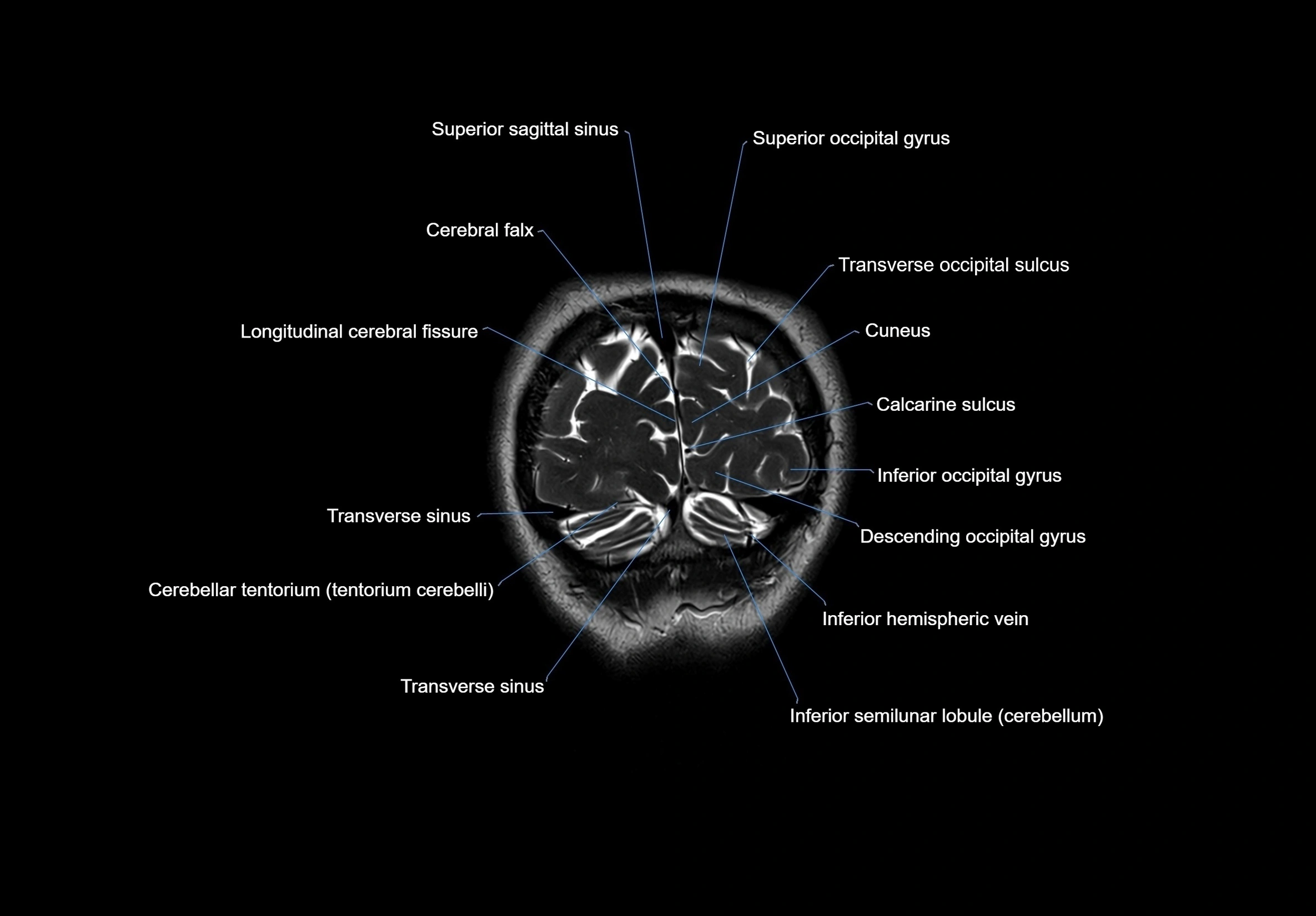 MRI Brain coronal cross sectional labelled anatomy 3T image  -img-00001-00068.webp